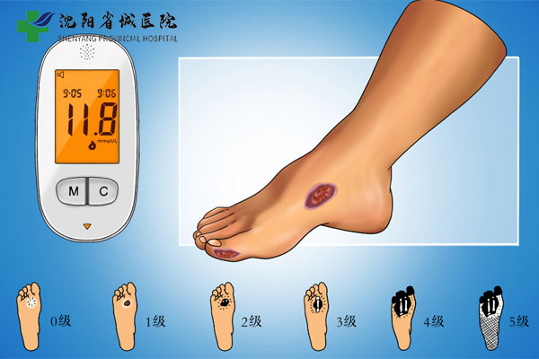 沈阳省城医院糖尿病中心:糖尿病人群怎么合理控制饮食
